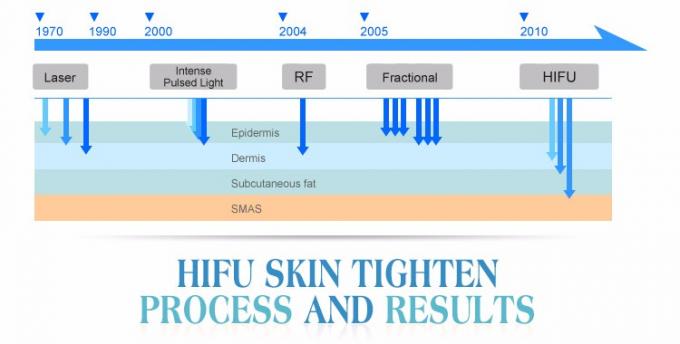 2016 machine médicale de hifu du soin SMAS de ride de traitement facial de retrait